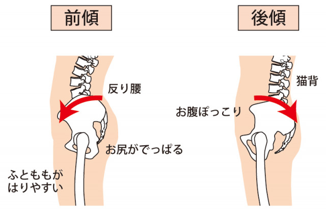 骨盤の前傾がモートン病の原因になります