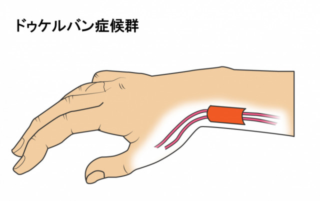 ドケルバンとは?